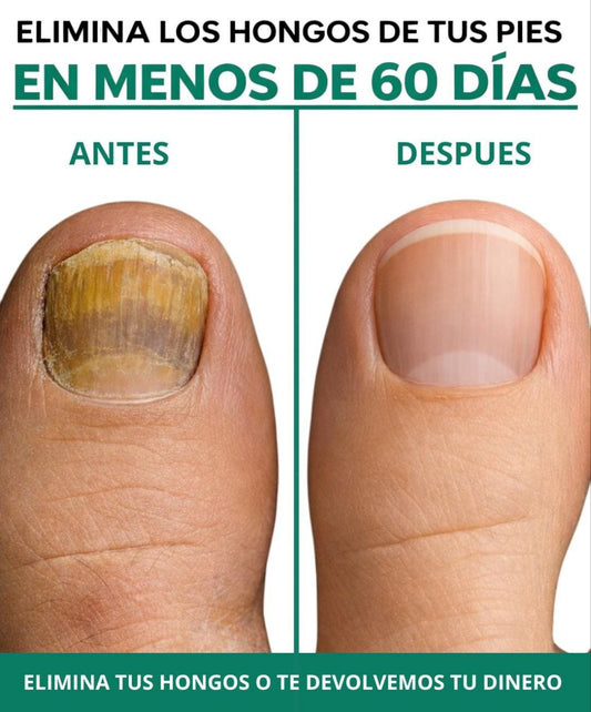 BenditoUru - Parches Antihongos - Eliminan Hongos y Regeneran tus Uñas